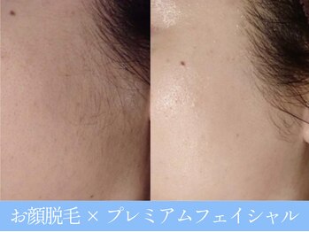 オーシャンブルー 大分店(OCEAN BLUE)/顔脱毛×プレミアムフェイシャル