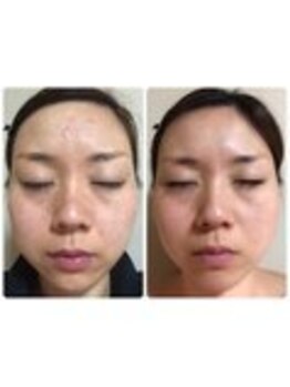 ビューティー モア 長岡店(More)/ニキビケアも★ハーブピーリング