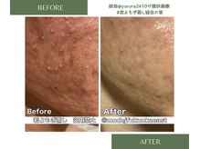 凛/若よもぎ蒸し　Before/After