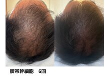 ボニータ(Bonita)/【頭皮Lit】ヒト臍帯幹細胞