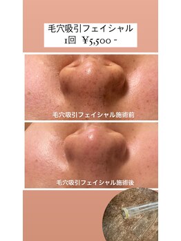 ルクール(Le Coeur)/VOSサロンケアに追加で毛穴吸引