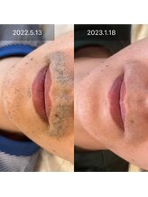 ビューティリュクス(beauty luxe)/美肌脱毛が人気！！