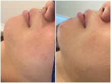 ベル(BeL)/ひげ脱毛（男性）24回