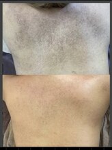 モッカ 北花田/背中ハーブピーリング　