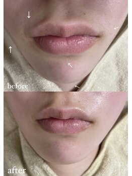 ミーミドットアイ(Mi-mi.i)/艶肌フェイシャルワックス脱毛