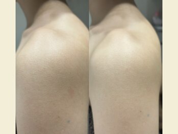 リタ 銀座(Rita)/シェービング+エステ