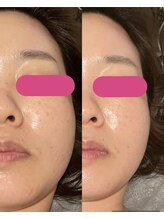 ビーメイクス(B・Makes)/プラズマフェイシャル