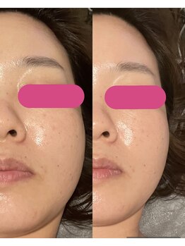 ビーメイクス(B・Makes)/プラズマフェイシャル