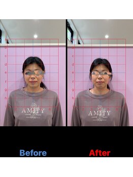 カルミア鍼灸接骨院/美容鍼ビフォーアフター