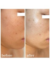 ココ(COCO)/ハーブピーリング/REVI/高知