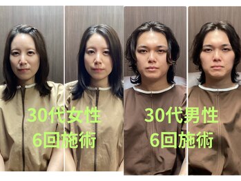 ハナレ(HANARe)/美容鍼/30代男女