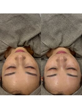 クレビア(CREBIA)/季節の変わり目が荒れやすい人