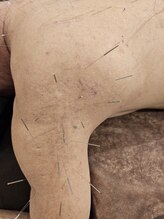 はりきゅう和 ルート鍼灸院/皮ふの状態