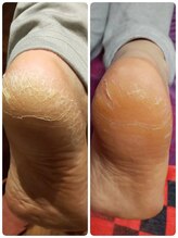 ラフ(laugh)/かかとのひび割れ