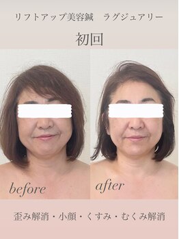 めい鍼灸院/美容鍼灸 ビフォーアフター