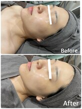 ヴィヴィエ 佐賀店(ViVier)/ララピール症例　1回