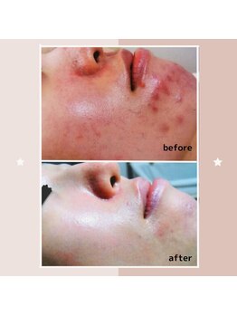 レゾン 京橋店/【ビフォーアフター】ニキビケア