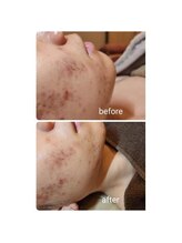 ジャドール ネイルアンドアイラッシュ(J'ADORE)/ハーブピーリング