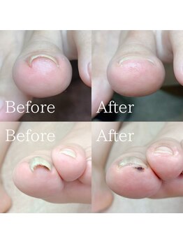 あしから/巻き爪の処置