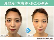 ナチュラルビューティーフェイス 横浜(NBF)/左右差・顎の歪み/30代
