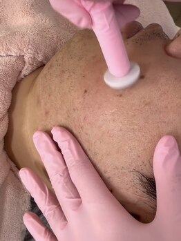 レナセール(Renacer)の写真/【プロセルセラピーズ】凸凹毛穴など、美容施術でも難しいお肌のお悩みを改善！毛穴悩みはお任せください！