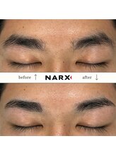 ナークス(NARX)/【眉毛脱毛】ビフォーアフター