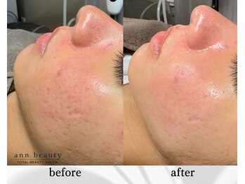 アン ビューティー(ann beauty)/施術1回【症例写真】10代