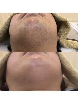 ビビ/脱毛/メンズ脱毛/全身脱毛/髭