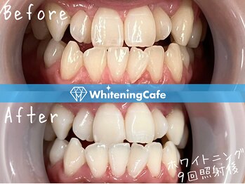 ホワイトニングカフェ 松本店(WhiteningCafe)/ホワイトニングビフォーアフター