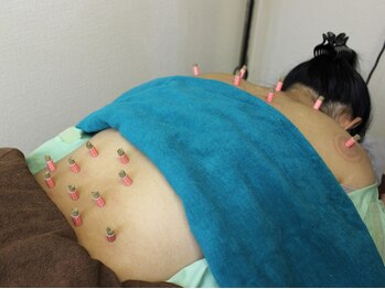 いなほ はりきゅう整骨院 東新宿/鍼灸(吸い玉併用)コース