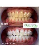 ホワイトニングサロン 名古屋駅店/【ホワイトニング施術例】