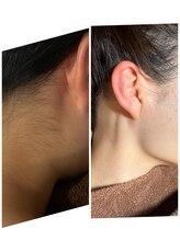 リンク(LINK.)/うなじ光脱毛＋ワックス脱毛