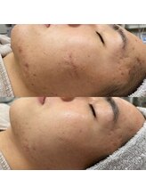 サロンドブランシール(salon de blanchir)/跡でお悩みの方におすすめ