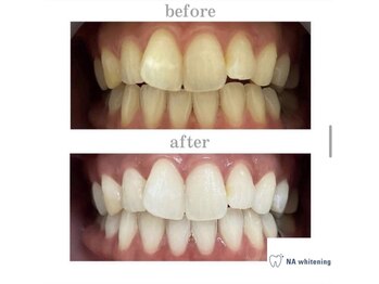 NAホワイトニング 自由が丘店/【before/after】