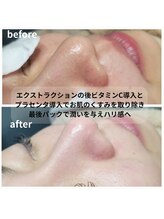 サロン ザ プマロ(SalonThePumalo)/くすみ・毛穴ケア