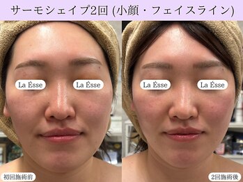 ラエッセ(La Esse)/小顔&フェイスライン