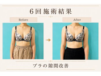 ネイト ワックス(Neit Wax)/ブラの隙間改善!