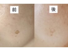 ルビーサロン(ruby-salon)の雰囲気（お顔のシミをピンポイントで排出[西脇市/シミケア/ヘッドスパ]）