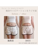 ルシアル(Rucial)/痩身◇Before/After