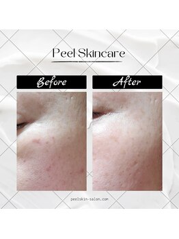 水光ピールスキン/お肌管理は継続が大事です！