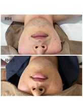 ウルル(ULuLu)/ヒゲ脱毛　ビフォーアフター