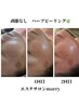 【人気No1】肌質改善ハーブピーリング+毛穴洗浄＋小顔リンパ＋パック¥11,500