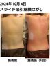 スライドカッピング吸引筋膜ほぐし　サイズダウンチャレンジ120分