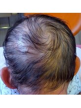 エステティック パルフェ/頭皮でお悩みの方にフリーパス★