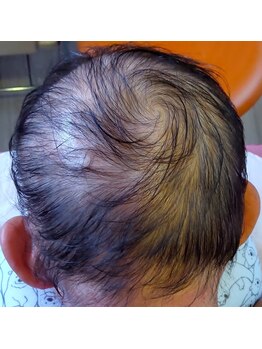 エステティック パルフェ/頭皮でお悩みの方にフリーパス★