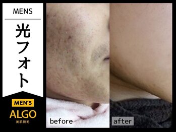 アルゴ 福井店(ALGO)/メンズ光フォト