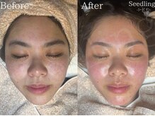 シードリン(Seedling)/フェイスワックス