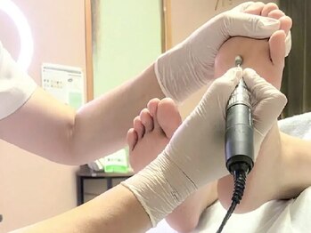 すみか(sumi家)の写真/巻き爪のスペシャリストによる施術で長年の爪の悩みを解消★施術の当日には日常生活を送っていただけます。