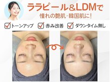 ハーブピーリング×韓国肌管理【&me福岡天神店】ピーリング/ララピール毛穴ニキビケアの雰囲気（今話題ララピール◎【ハーブ/ピーリング/ニキビケア/小顔/毛穴】）