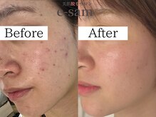 イーサム 高槻摂津富田店(e-sam)/光フェイシャル＆炭酸パック